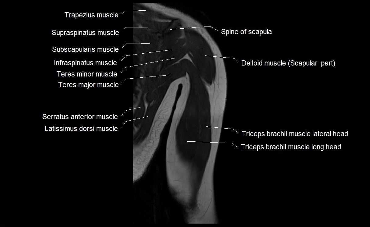 MRI upper arm (humerus ) coronal cross sectional anatomy image 24.webp